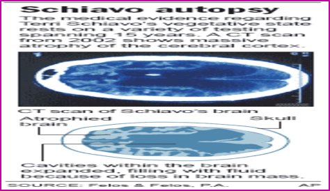 What Happened To Terri Schiavo Brain? Autopsy Reveal And Documentary Details